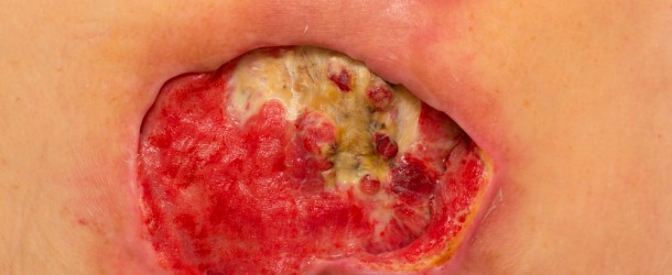 Texto, Audio y Vídeo sobre APÓSITOS CONVENCIONALES y APÓSITOS para ÚLCERAS